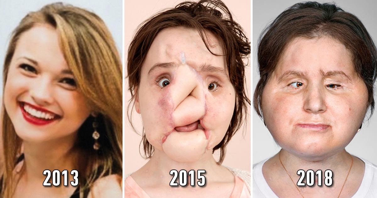 Suicide survivor gave life a second chance with Historic face transplant