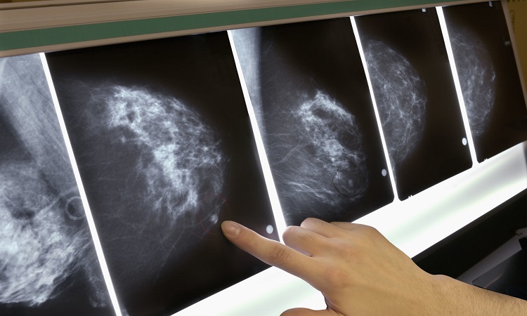 MIT develops artificial intelligence that predicts breast cancer 5 years earlier
