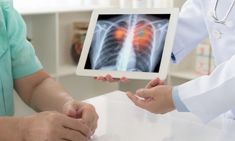 Immunotherapy is a life expectancy for lung cancer patients