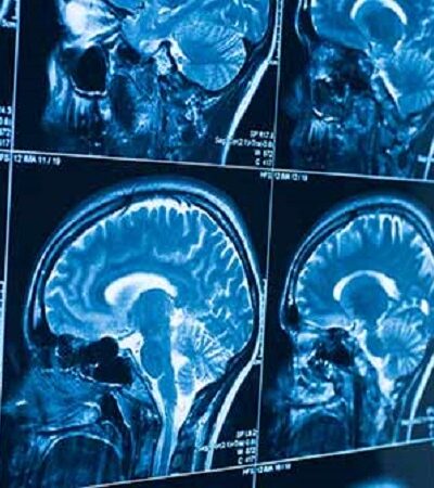 Brain tumors: scientific advances give patients better life expectancy