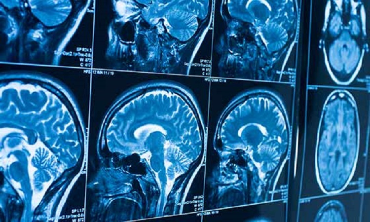 Brain tumors: scientific advances give patients better life expectancy