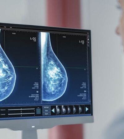 Radiological diagnosis of breast cancer: AI for better patient care